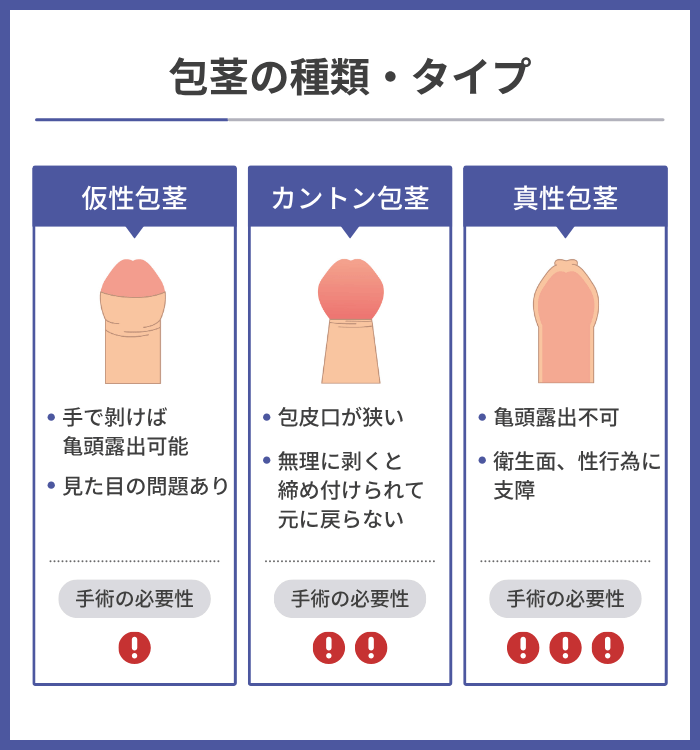 包茎の種類・タイプ